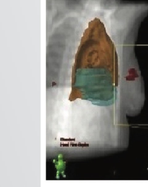 IMF Skin-Breast Wedge - Anwendung